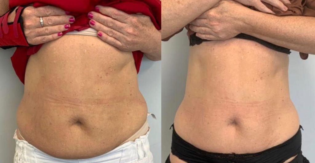 The Best Body-Contouring Procedures with Fast Results