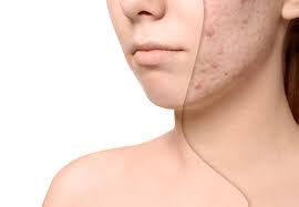 Advanced Aesthetics:  Cosmetic_Laser Therapy To Treat Scars